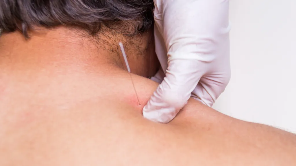 Dry needling shoulder treatment at Ascend Acupuncture Byron Bay