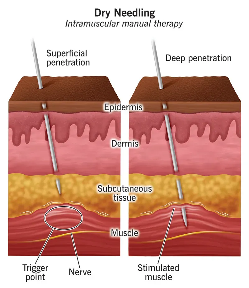 Muscle Trigger point dry needling and the clinical application
