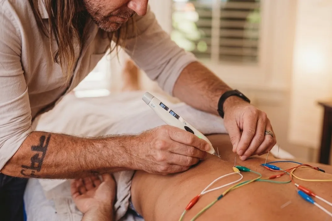 Motor point needling electrostimulation treatment Byron Bay