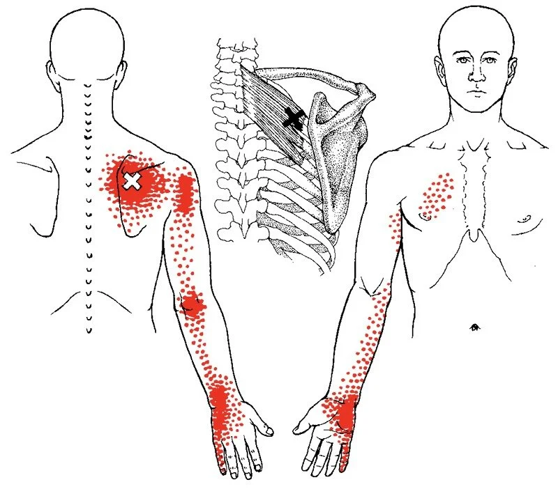 Trigger point dry needling treatment at Ascend Acupuncture Byron Bay